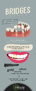 Dental Bridge – Discovery Dental WA