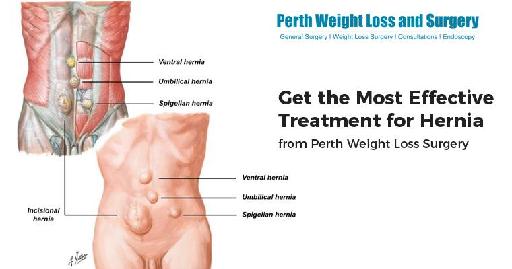 Effective Treatment for Hernia from Perth Weight Loss Surgery